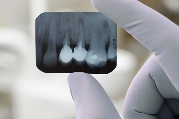 Digital Dental X-Ray’s