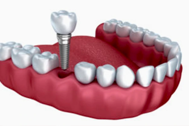 Implants Crowns