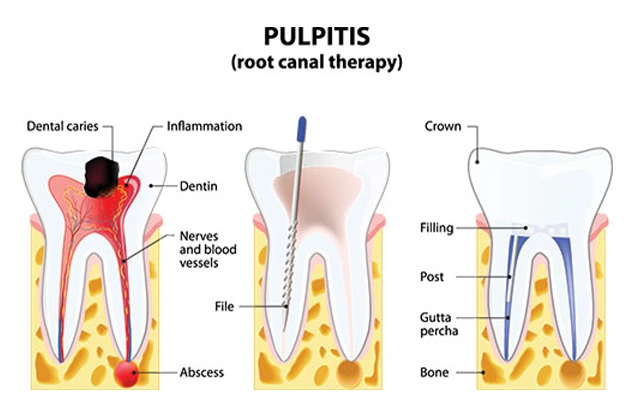 Root Canal